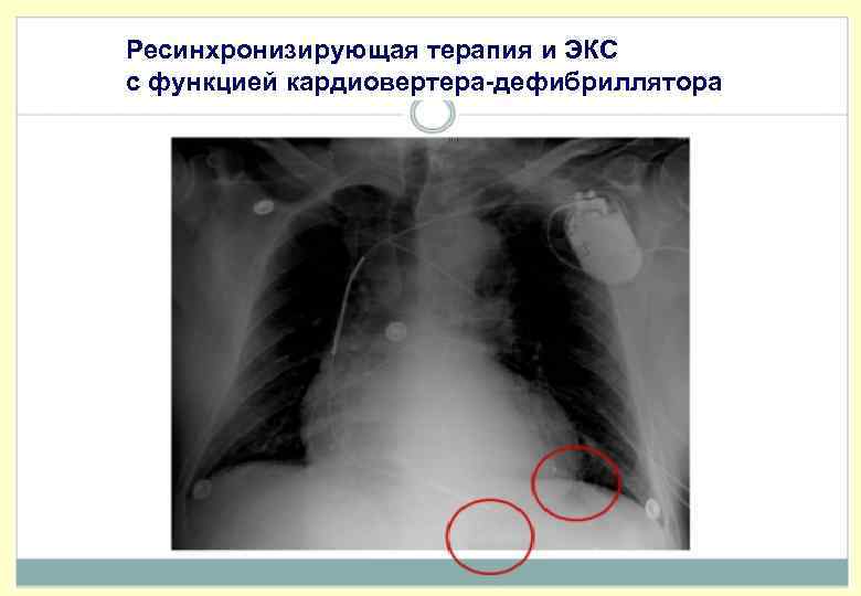 Ресинхронизирующая терапия и ЭКС с функцией кардиовертера-дефибриллятора 