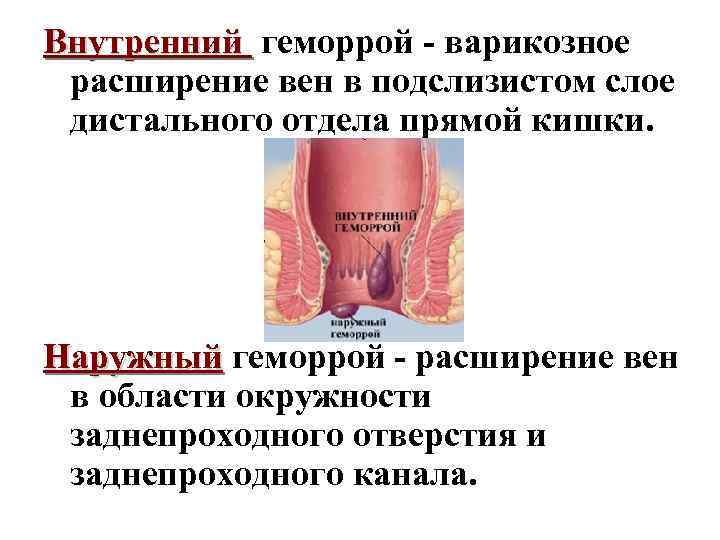 Внутренний геморрой - варикозное расширение вен в подслизистом слое дистального отдела прямой кишки. Наружный