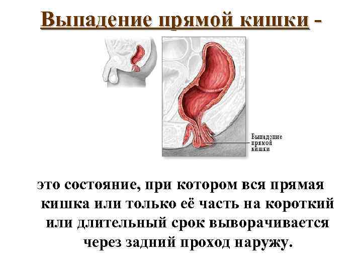 Выпадение прямой кишки - это состояние, при котором вся прямая кишка или только её