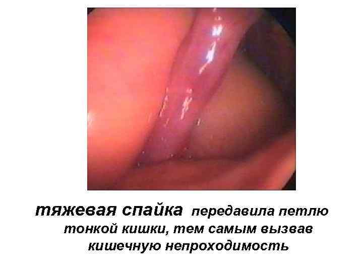 тяжевая спайка передавила петлю тонкой кишки, тем самым вызвав кишечную непроходимость 