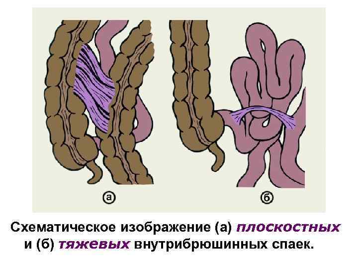 План лечения острого аппендицита