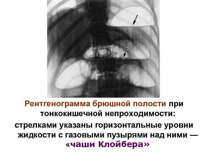 Полость заполнена жидкостью. Тонкокишечная непроходимость рентген. Чаши Клойбера на рентгенограмме. Обзорная рентгенограмма брюшной полости чаши Клойбера.