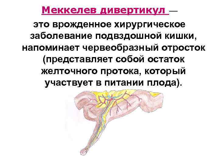 Дивертикул меккеля у детей презентация