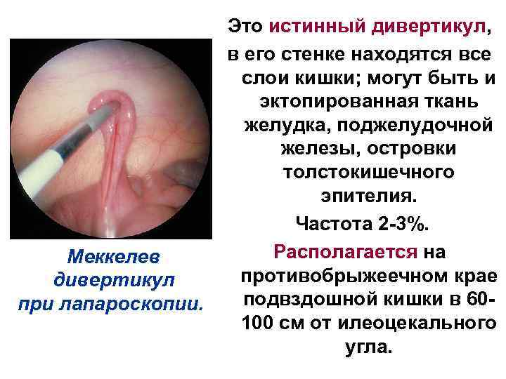 Это истинный дивертикул, в его стенке находятся все слои кишки; могут быть и эктопированная