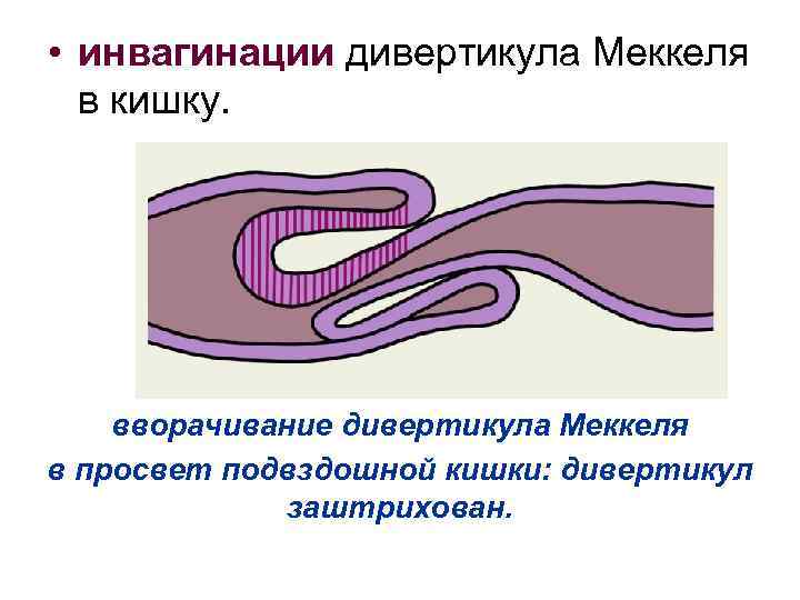  • инвагинации дивертикула Меккеля в кишку. вворачивание дивертикула Меккеля в просвет подвздошной кишки: