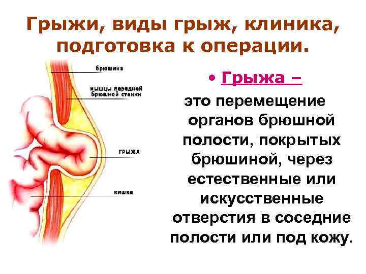 Грыжи живота госпитальная хирургия презентация