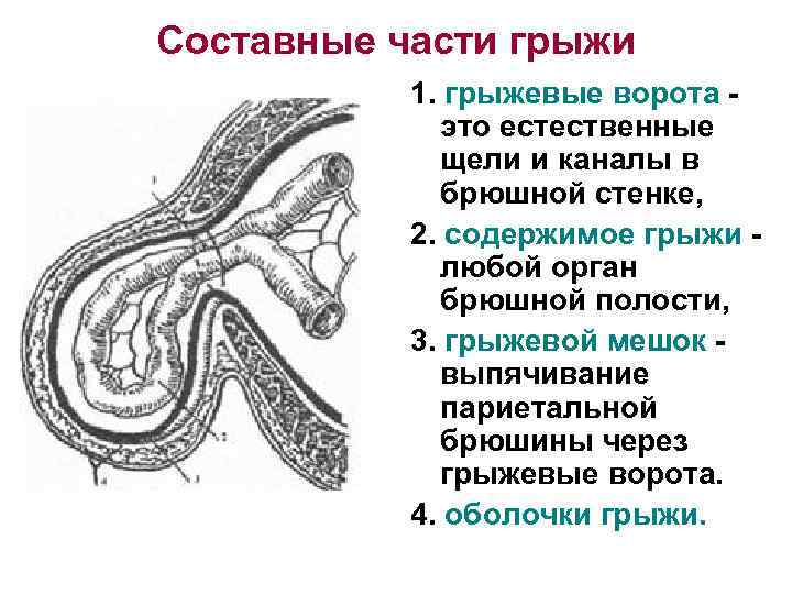 Пупочная грыжа рисунок схема