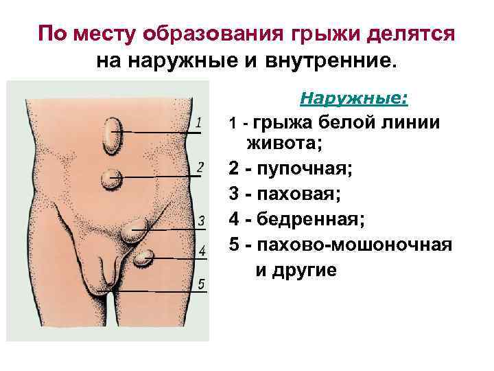 По месту образования грыжи делятся на наружные и внутренние. Наружные: 1 - грыжа белой