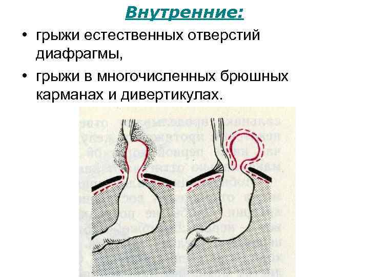 Наружные и внутренние грыжи живота презентация