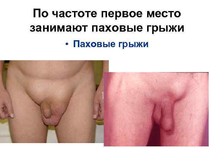 По частоте первое место занимают паховые грыжи • Паховые грыжи 