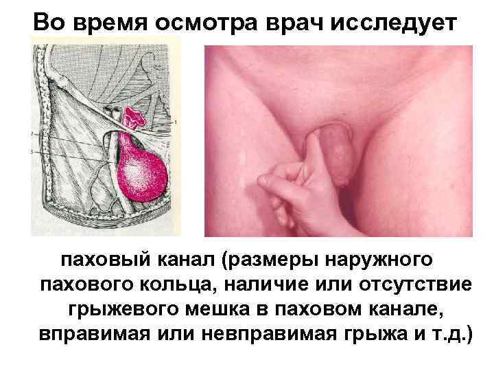 Во время осмотра врач исследует паховый канал (размеры наружного пахового кольца, наличие или отсутствие