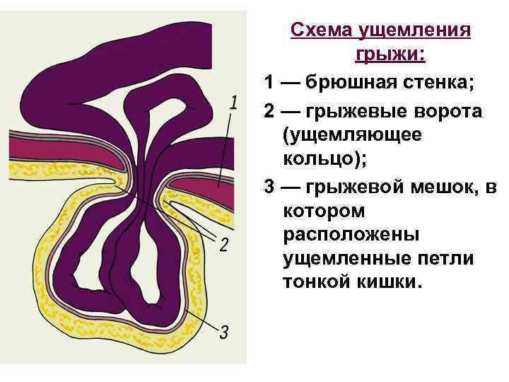 Грыжа брюшной стенки карта вызова