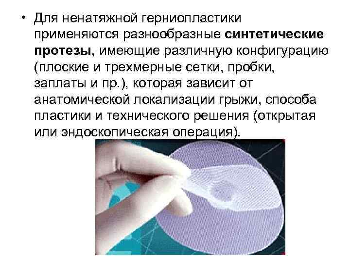  • Для ненатяжной герниопластики применяются разнообразные синтетические протезы, имеющие различную конфигурацию (плоские и