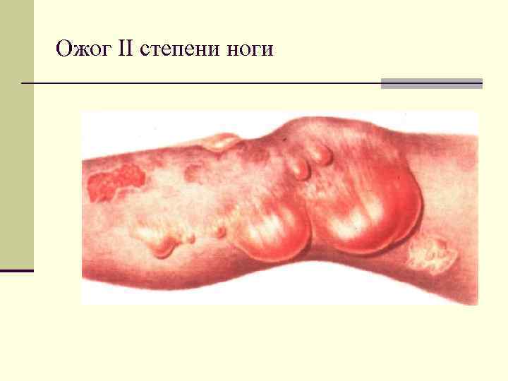 Ожог II степени ноги 
