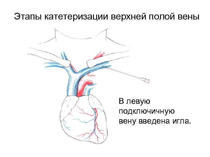 Этапы катетеризации верхней полой вены В левую подключичную вену введена игла. 