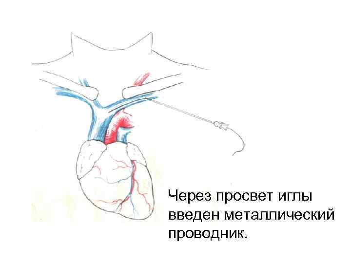 Через просвет иглы введен металлический проводник. 