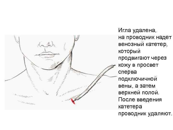 Игла удалена, на проводник надет венозный катетер, который продвигают через кожу в просвет сперва
