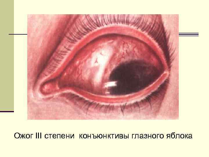 Ожог III степени конъюнктивы глазного яблока 