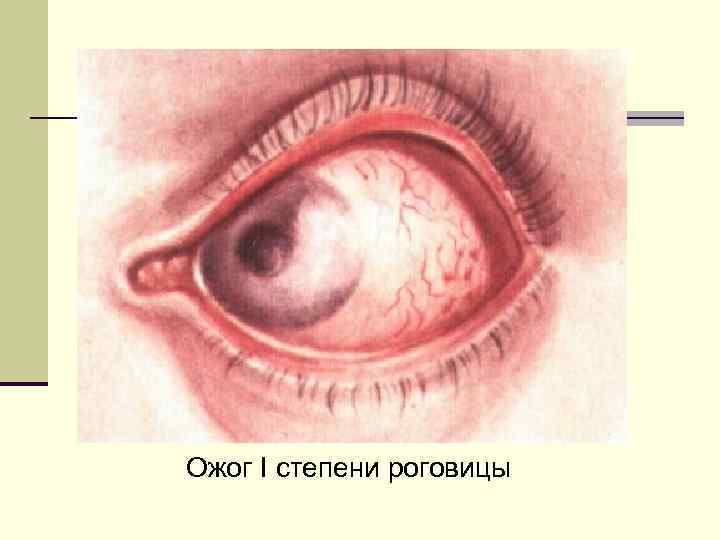 Ожог I степени роговицы 