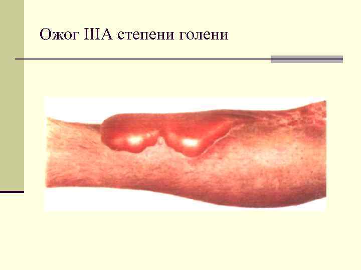 Ожог IIIА степени голени 