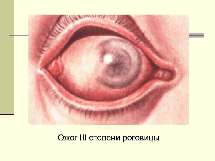 Ожог III степени роговицы 