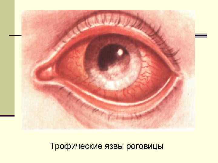 Трофические язвы роговицы 