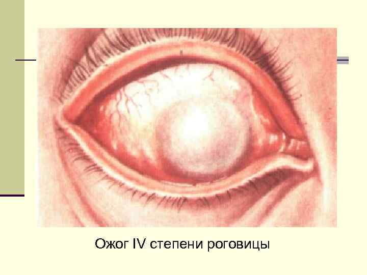 Ожог IV степени роговицы 