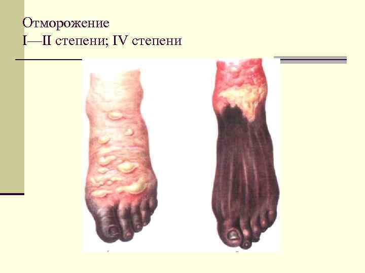 Отморожение I—II степени; IV степени 