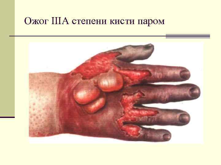 Ожог IIIА степени кисти паром 