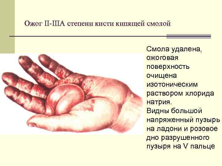 Ожог II IIIА степени кисти кипящей смолой Смола удалена, ожоговая поверхность очищена изотоническим раствором