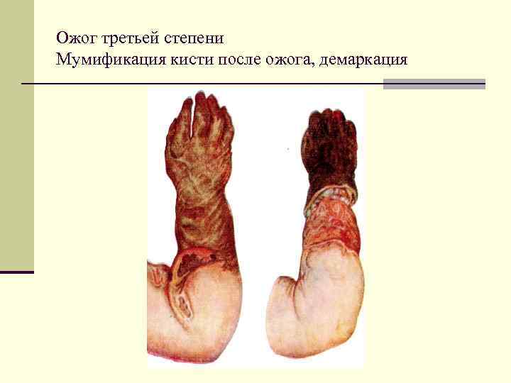 Ожог третьей степени Мумификация кисти после ожога, демаркация 