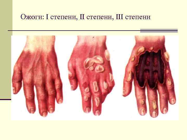 Ожоги: I степени, III степени 