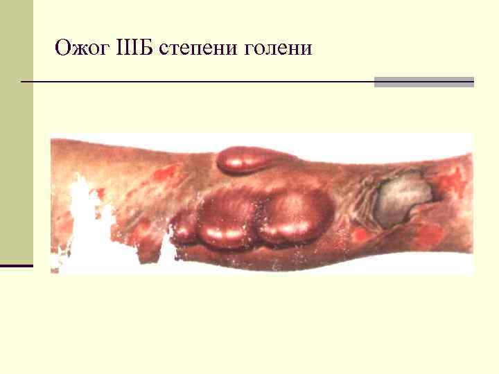 Ожог IIIБ степени голени 