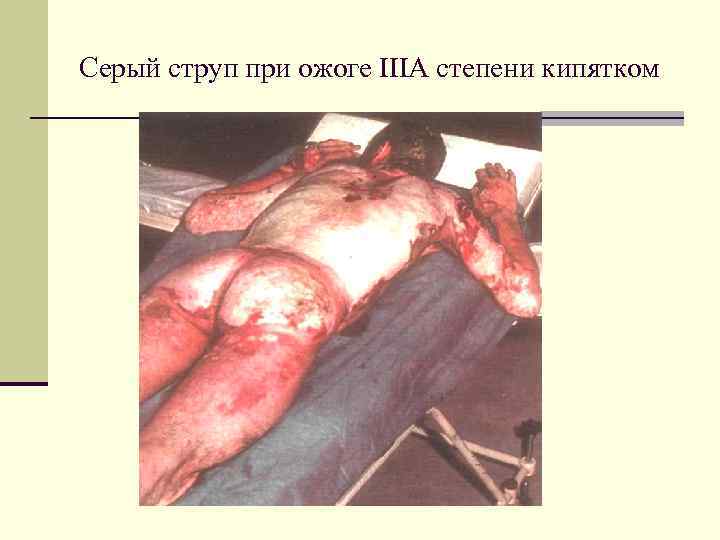 Серый струп при ожоге IIIА степени кипятком 