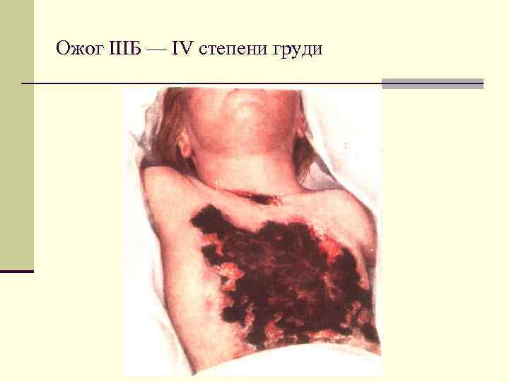 Ожог IIIБ — IV степени груди 