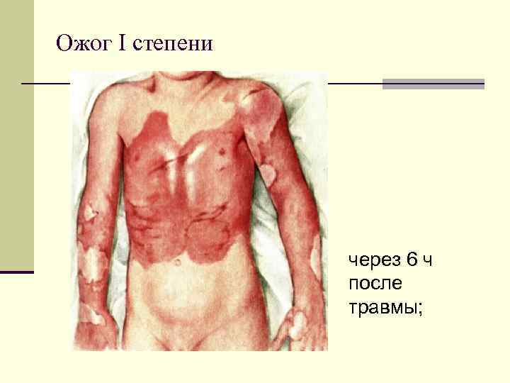 Ожог I степени через 6 ч после травмы; 