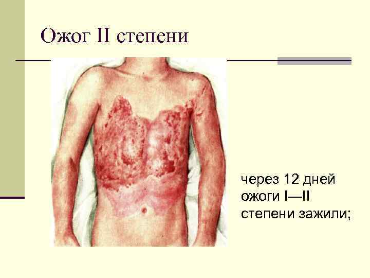 Ожог II степени через 12 дней ожоги I—II степени зажили; 