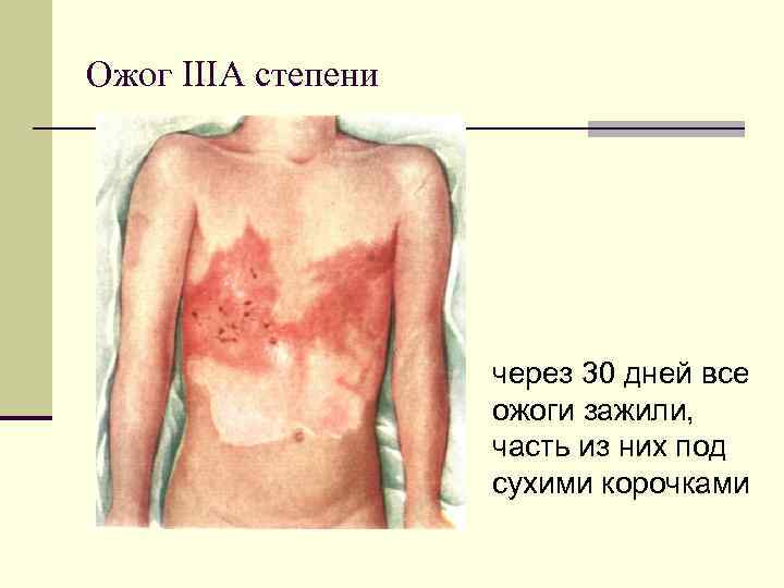Ожог IIIА степени через 30 дней все ожоги зажили, часть из них под сухими