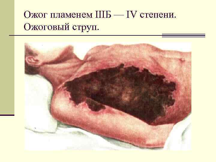 Ожог пламенем IIIБ — IV степени. Ожоговый струп. 