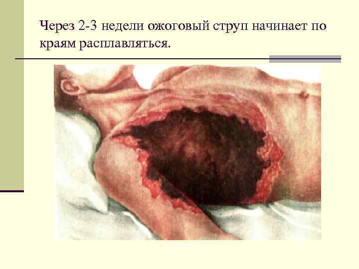 Через 2 3 недели ожоговый струп начинает по краям расплавляться. 