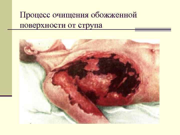 Процесс очищения обожженной поверхности от струпа 