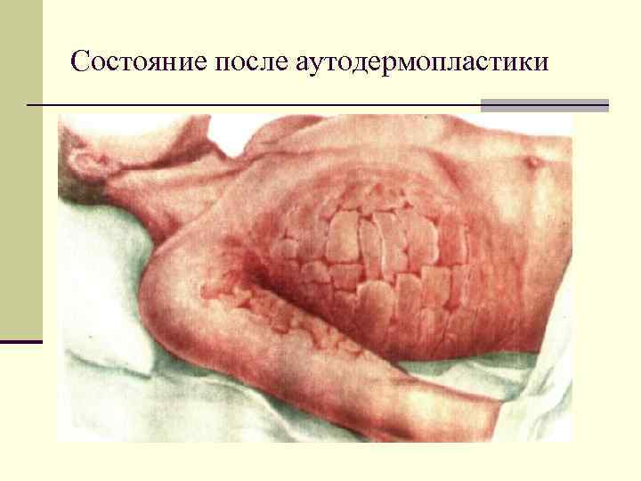 Состояние после аутодермопластики 