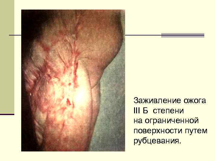 Заживление ожога III Б степени на ограниченной поверхности путем рубцевания. 
