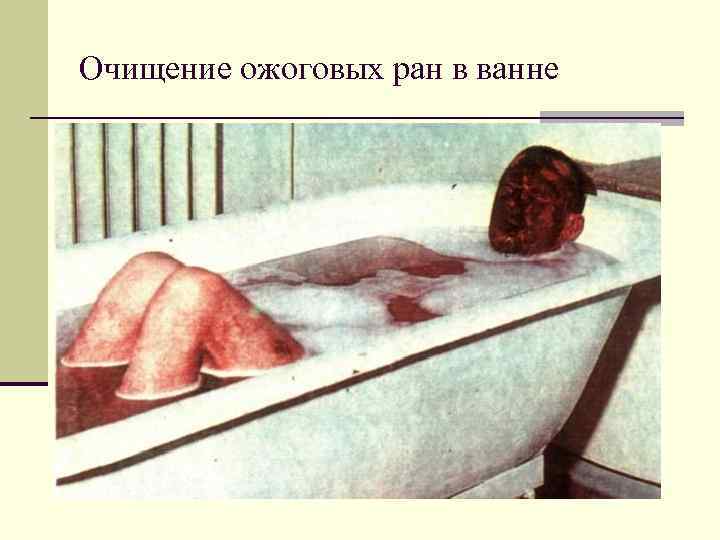 Очищение ожоговых ран в ванне 