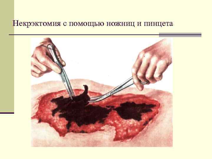 Некрэктомия с помощью ножниц и пинцета 