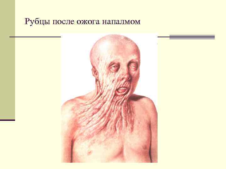 Рубцы после ожога напалмом 