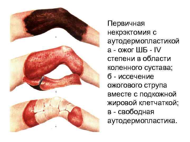 Первичная некрэктомия с аутодермопластикой а - ожог ШБ - IV степени в области коленного