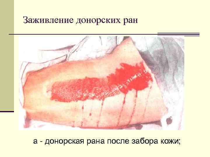 Заживление донорских ран а - донорская рана после забора кожи; 
