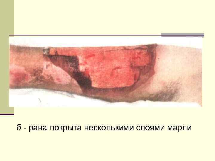б - рана локрыта несколькими слоями марли 