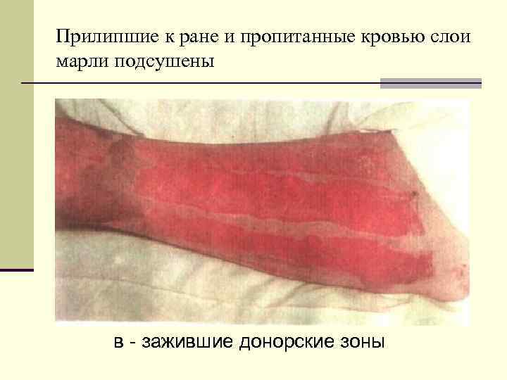 Прилипшие к ране и пропитанные кровью слои марли подсушены в - зажившие донорские зоны